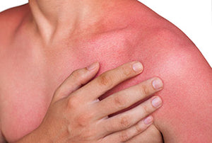 Calendula for Sunburns and Irritated Skin